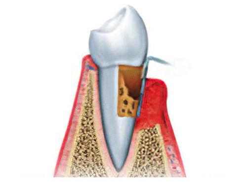 recommandations patients dentiste strasbourg maladies parodontales